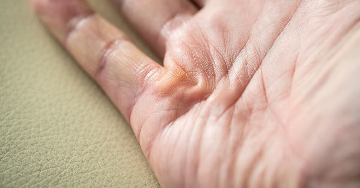 Dupuytren's Contracture